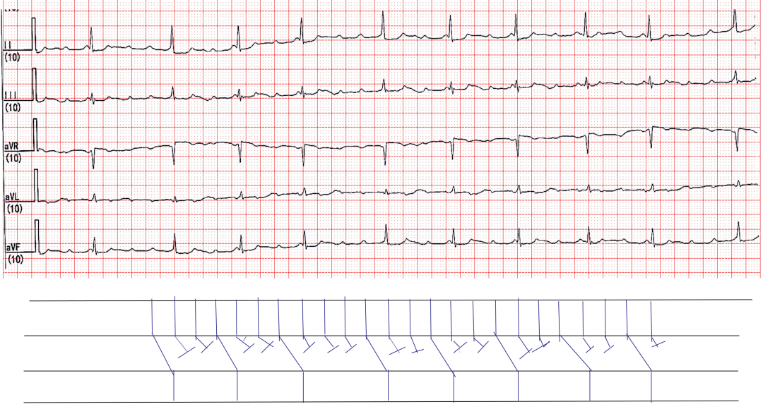 心电图解读房性心动过速伴病理性房室阻滞