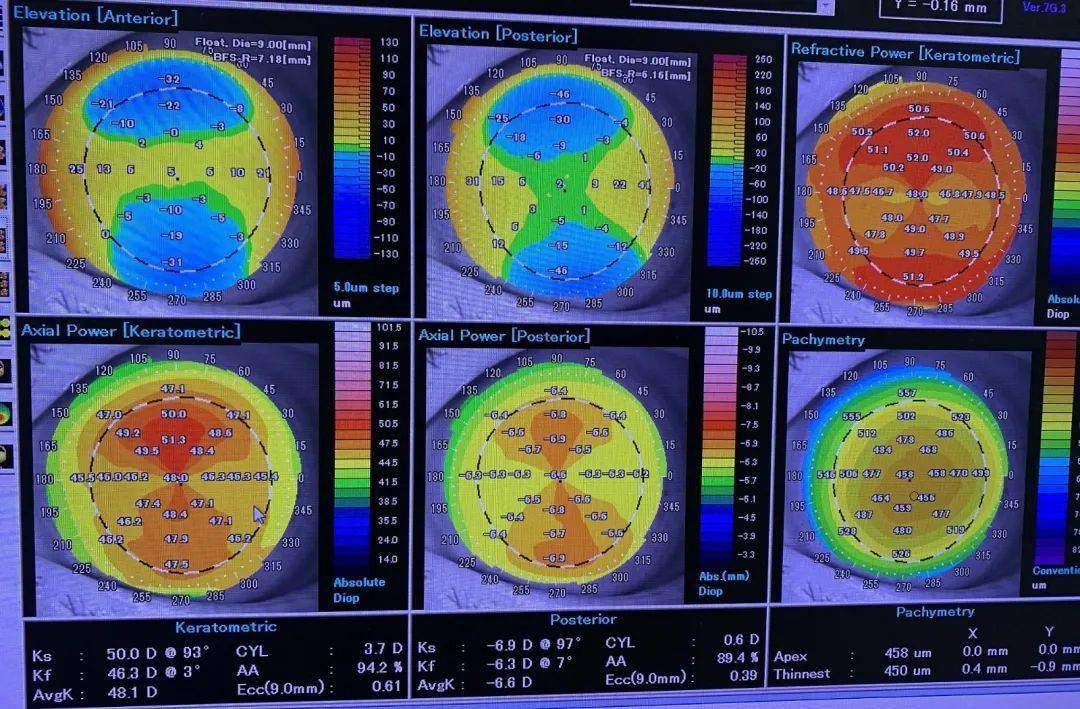 通过两个小时左右的检查时间可以得知视力,裂隙灯,眼底,眼压,角膜染色