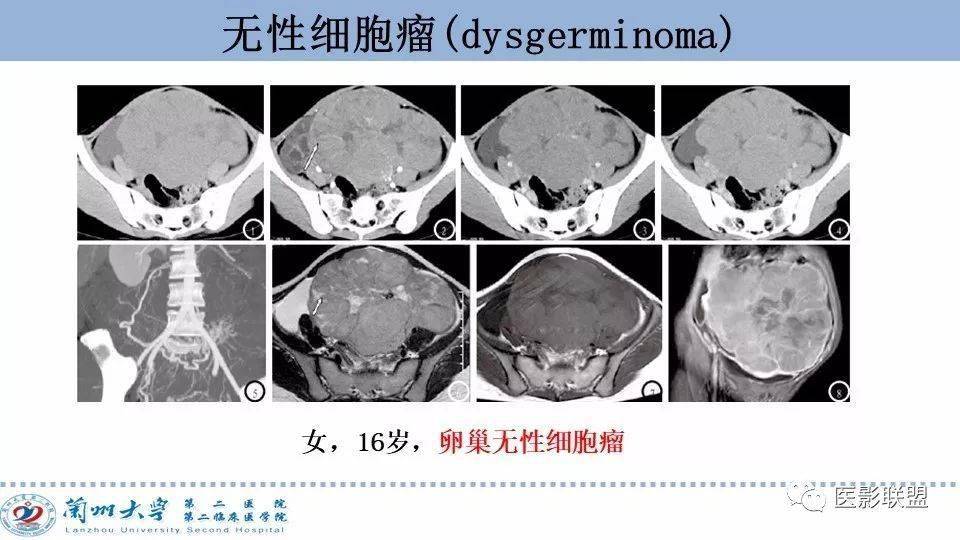 精彩ppt卵巢腫瘤mri診斷