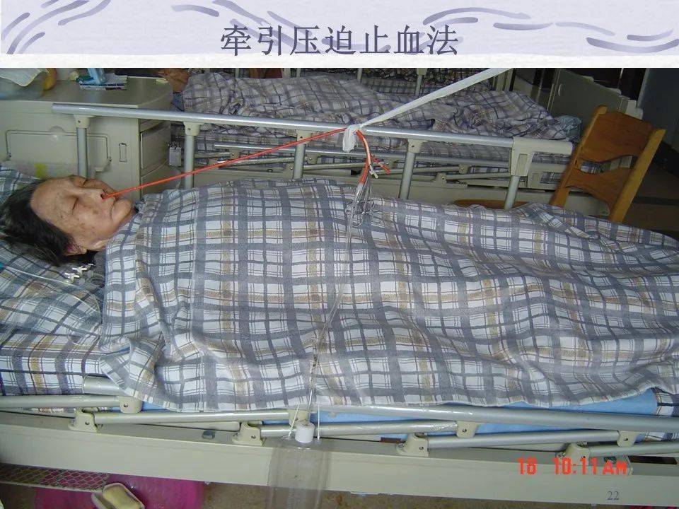 三腔二囊管的应用及护理_文库