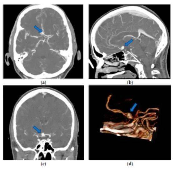 精選編譯vr技術可改善未破裂前交通動脈瘤解剖所見優化手術計劃