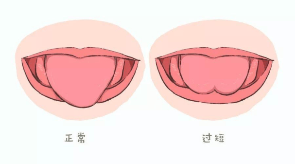 到底要不要剪我亲爱的舌系带