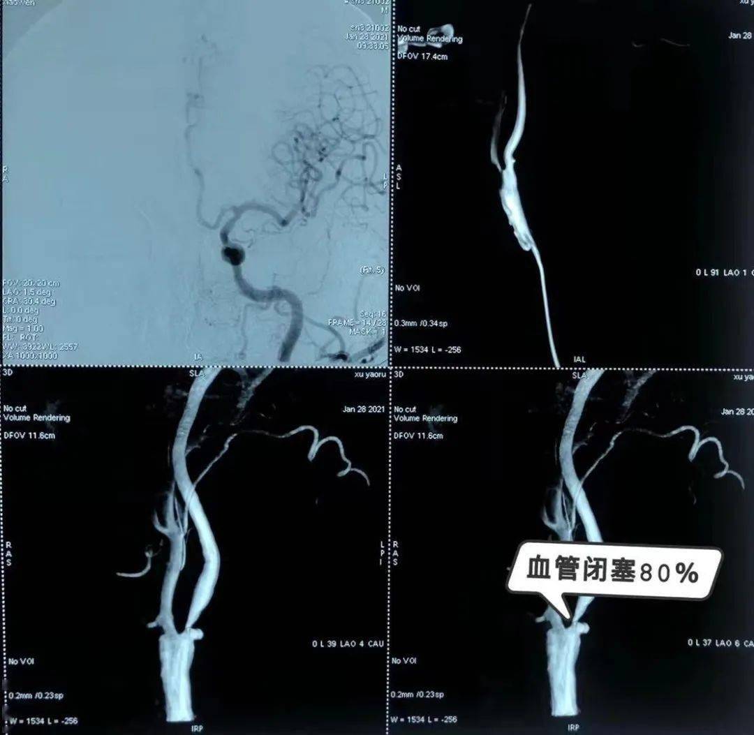 全腦血管 雙腎動脈造影示:左側頸內動脈開口處狹窄80%,李悅醫生告知