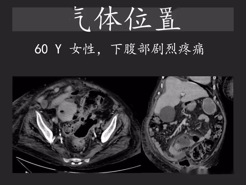 胃腸穿孔氣從哪裡來通過腹膜解剖確定穿孔部位