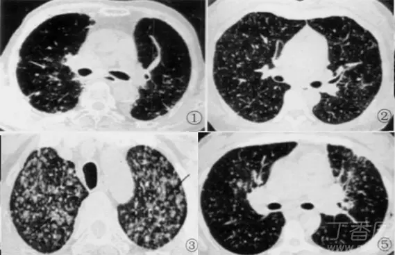 熟記這些 ct 表現,一眼識破轉移性肺癌_病灶