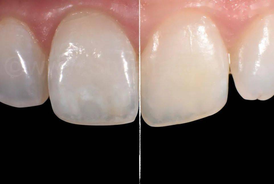 牙医学堂树脂渗透酸蚀终止的时机把握