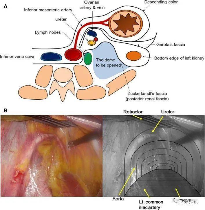 腹腔镜肾静脉下腹主动脉旁淋巴结切除术左侧穹隆形成法ldf