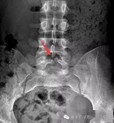 腰椎s1隐裂图片