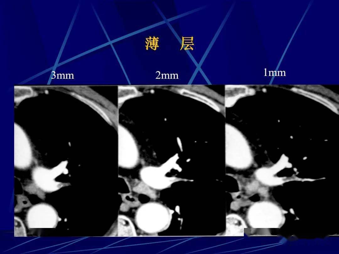 肺小結節影像診斷