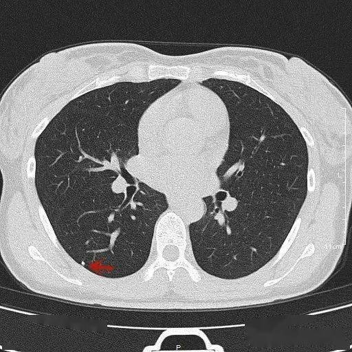 检查发现肺实性结节怎么办个人版实用指南