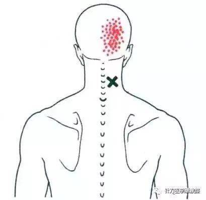 头半棘肌功能解剖