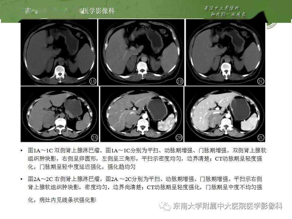 腹部肾上腺皮质癌影像诊断