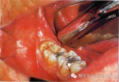 口腔麻醉拔牙術阻生牙拔除