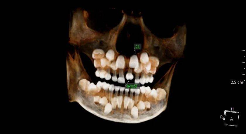 多牙症x光图片