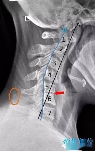 c3/4 椎间孔变窄(双斜位蓝色箭头),c5/6 段项韧带钙化(橙色区域内).