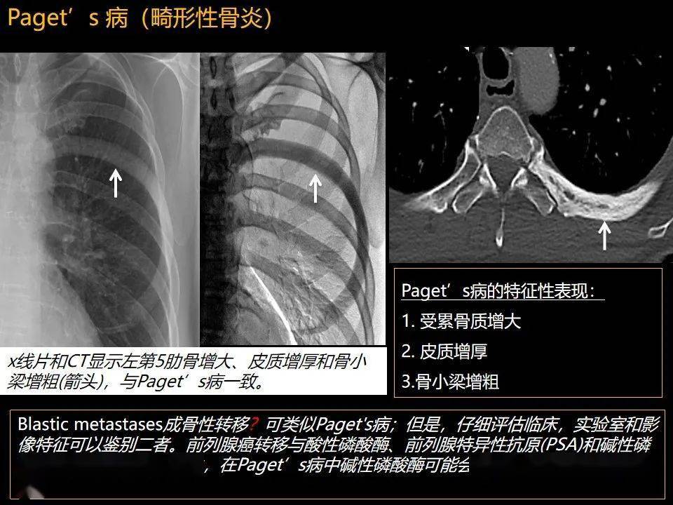 肋骨肿瘤肿瘤样病变及获得性非创伤性病变的影像诊断基本思路