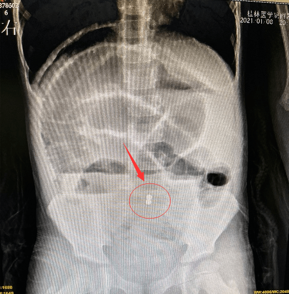 桂林4岁男童误食糖果致肠穿孔可能你家也有