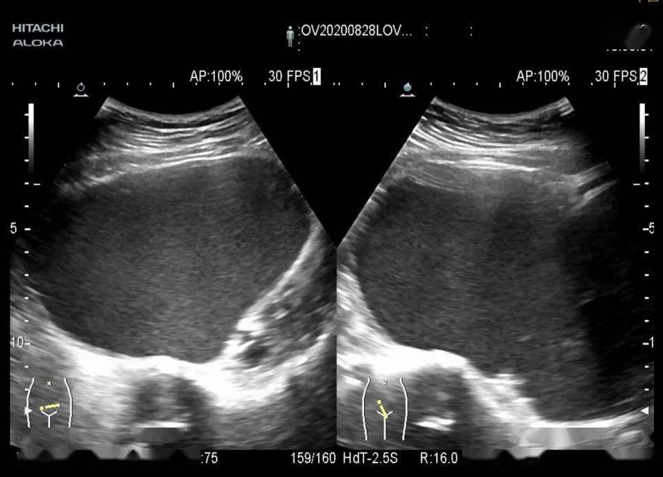 图5:术前超声显示右侧卵巢巨大巧克力囊肿经过充分的术前准备后,何光
