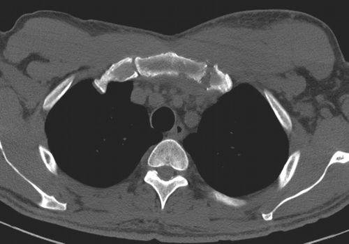 肋骨病变ct总结多图