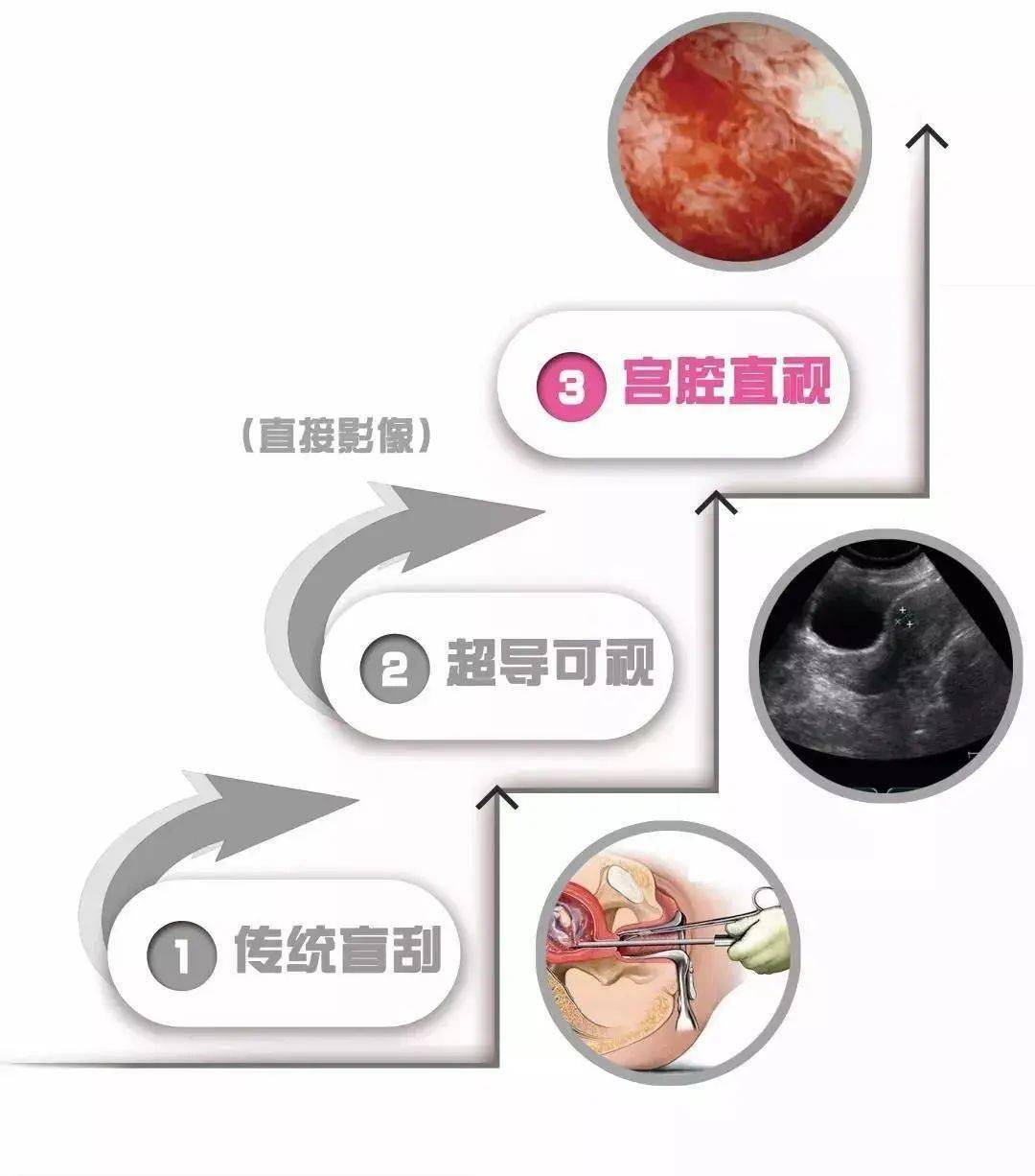 宫腔直视人流手术│减少子宫伤害,保护女性生育力