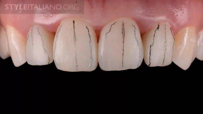 根管治疗后牙齿直接树脂修复的操作流程