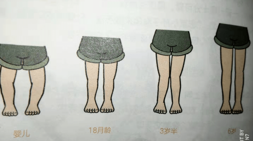 儿童腿型发育图图片