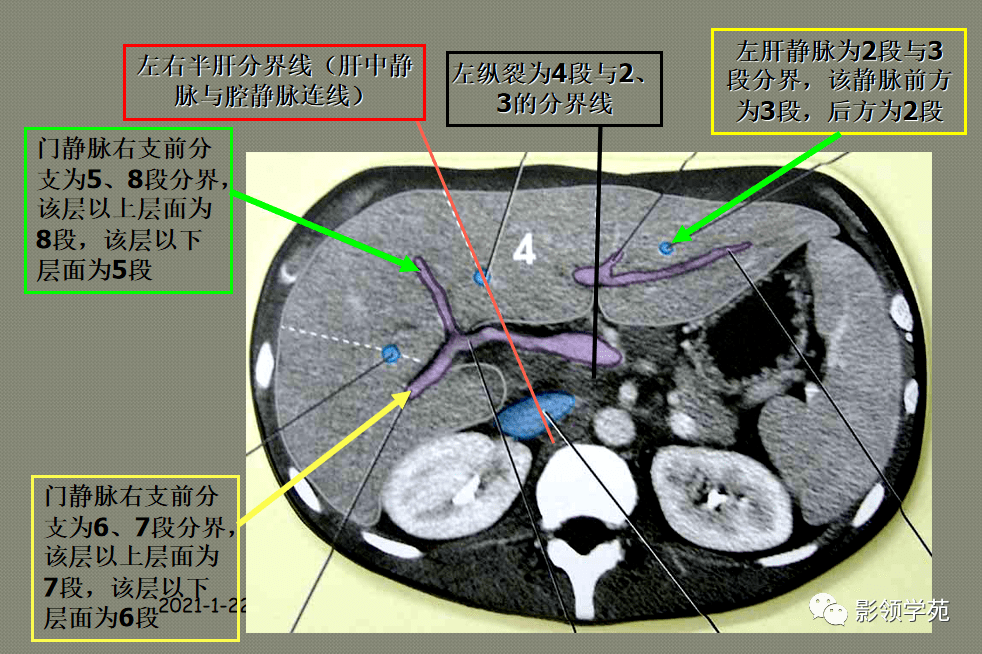 最全肝脏的表面解剖及分叶分段_门静脉
