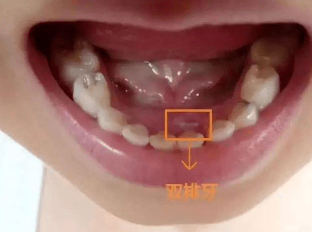把爱带回家(141) | 儿童营养与健康:健康防护我知道"孩子长出双排牙
