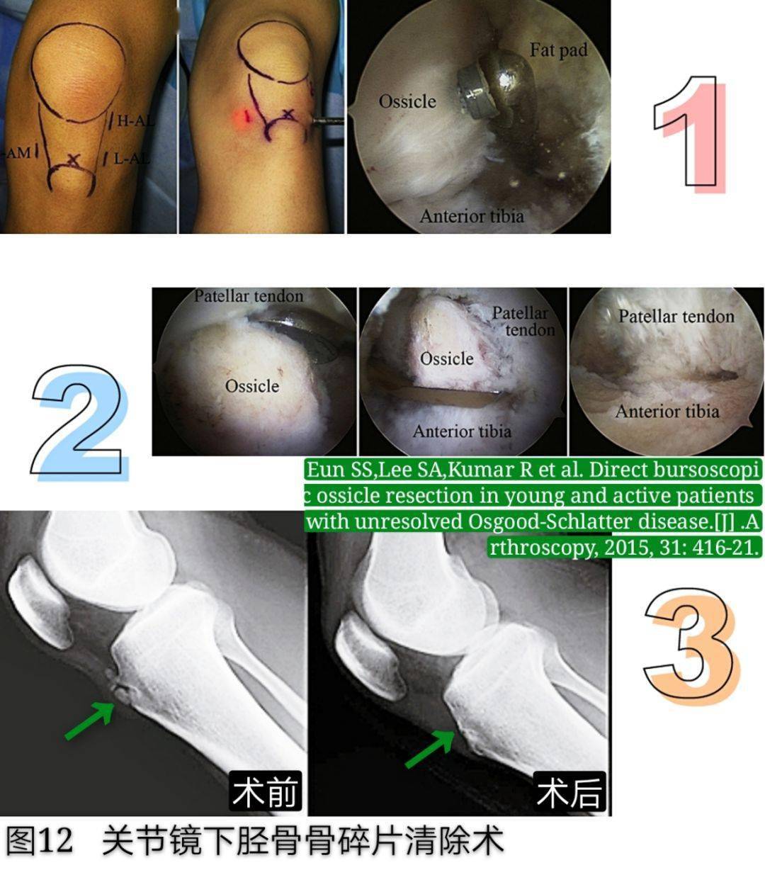 引起膝前痛的胫骨结节骨软骨炎你会诊治吗