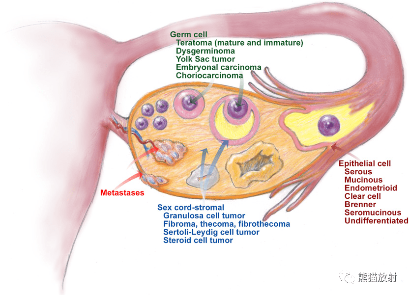 本文介绍了卵巢和远端输卵管的解剖结构,肿瘤组织学亚型的起源,卵巢