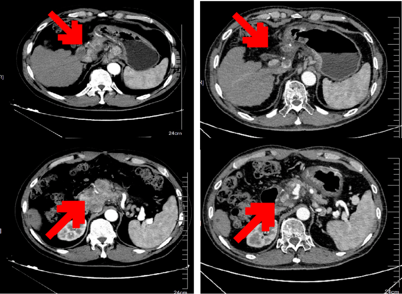 胃癌增强CT图像图片