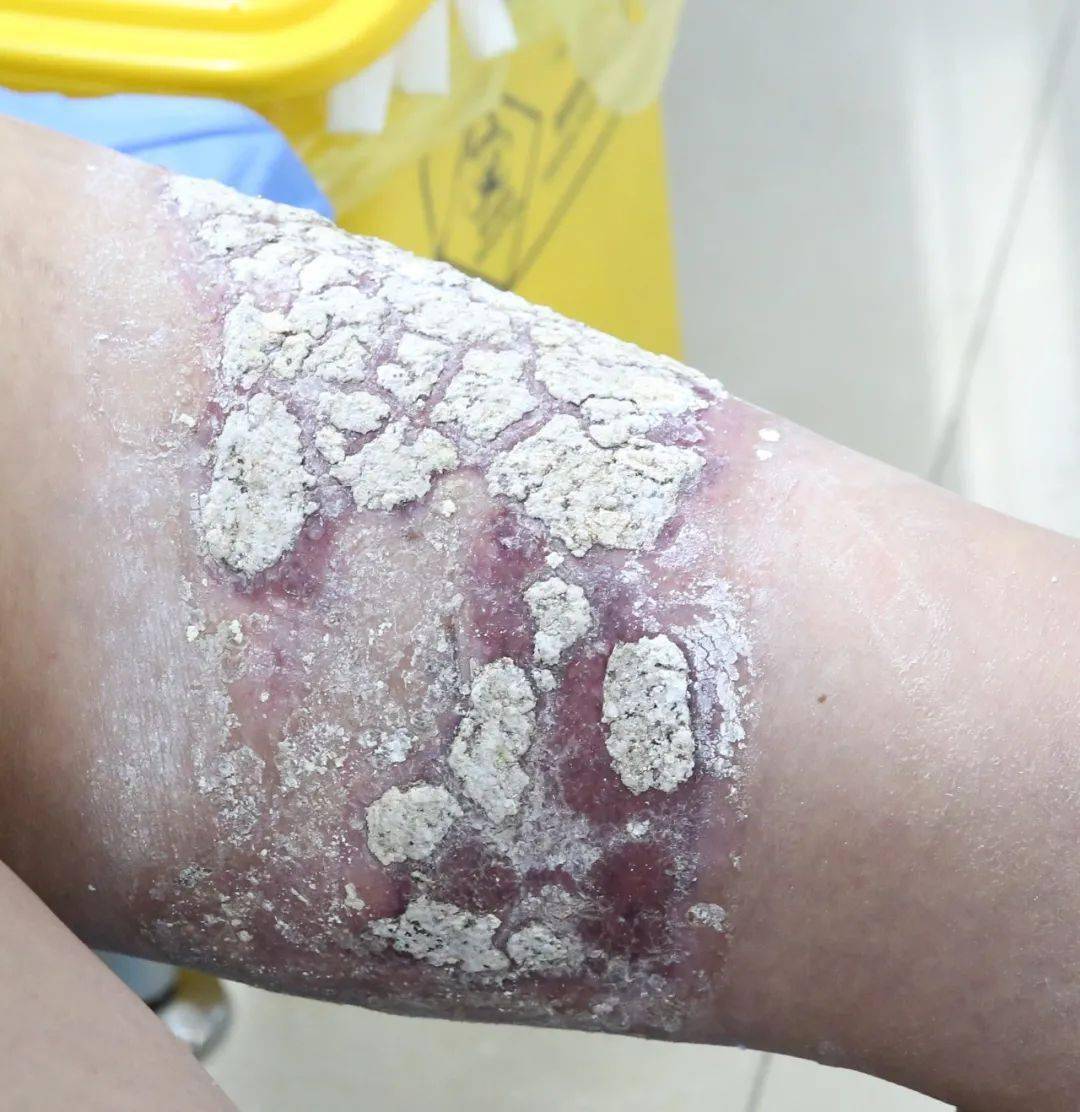 烧烫伤的原因各有不同,有热水烫伤,火焰烧伤,热水袋造成的低温烫伤等