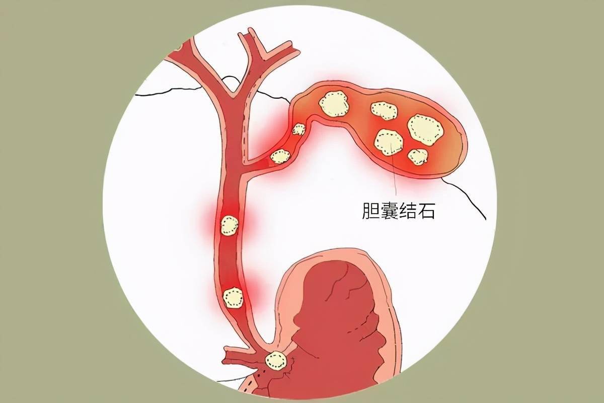 膽結石會引起膽囊癌嗎患有結石要定期做哪些檢查