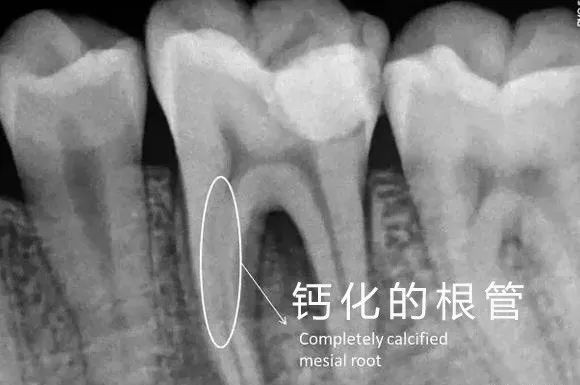 牙髓钙化图片图片