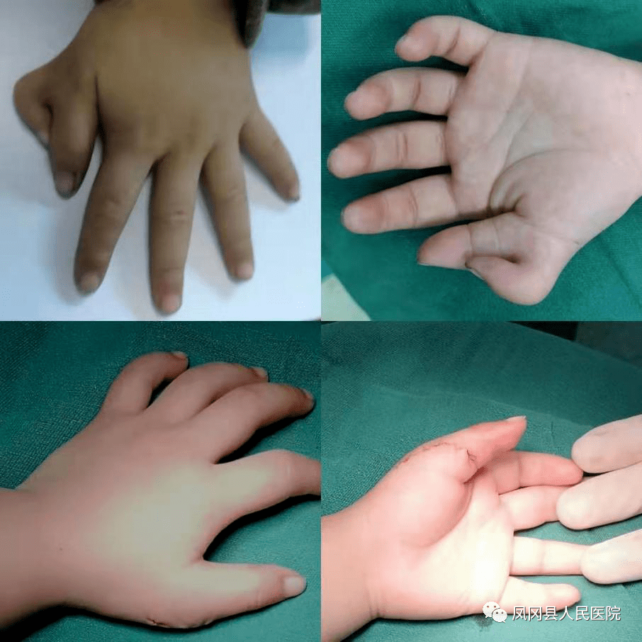 手指沾精怀孕的案例（用手桶怀孕了的案例）