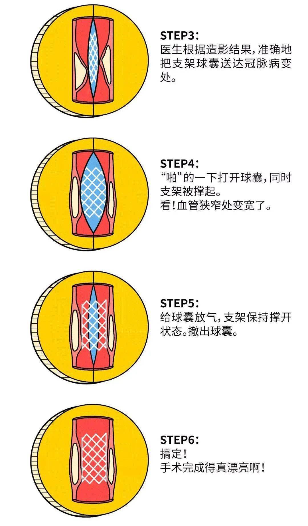 血管支架过程示意图图片