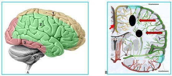 一文读懂干货脑分水岭梗死的解剖和分型