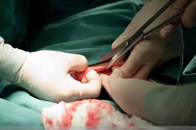 100张图片揭秘剖腹产全过程