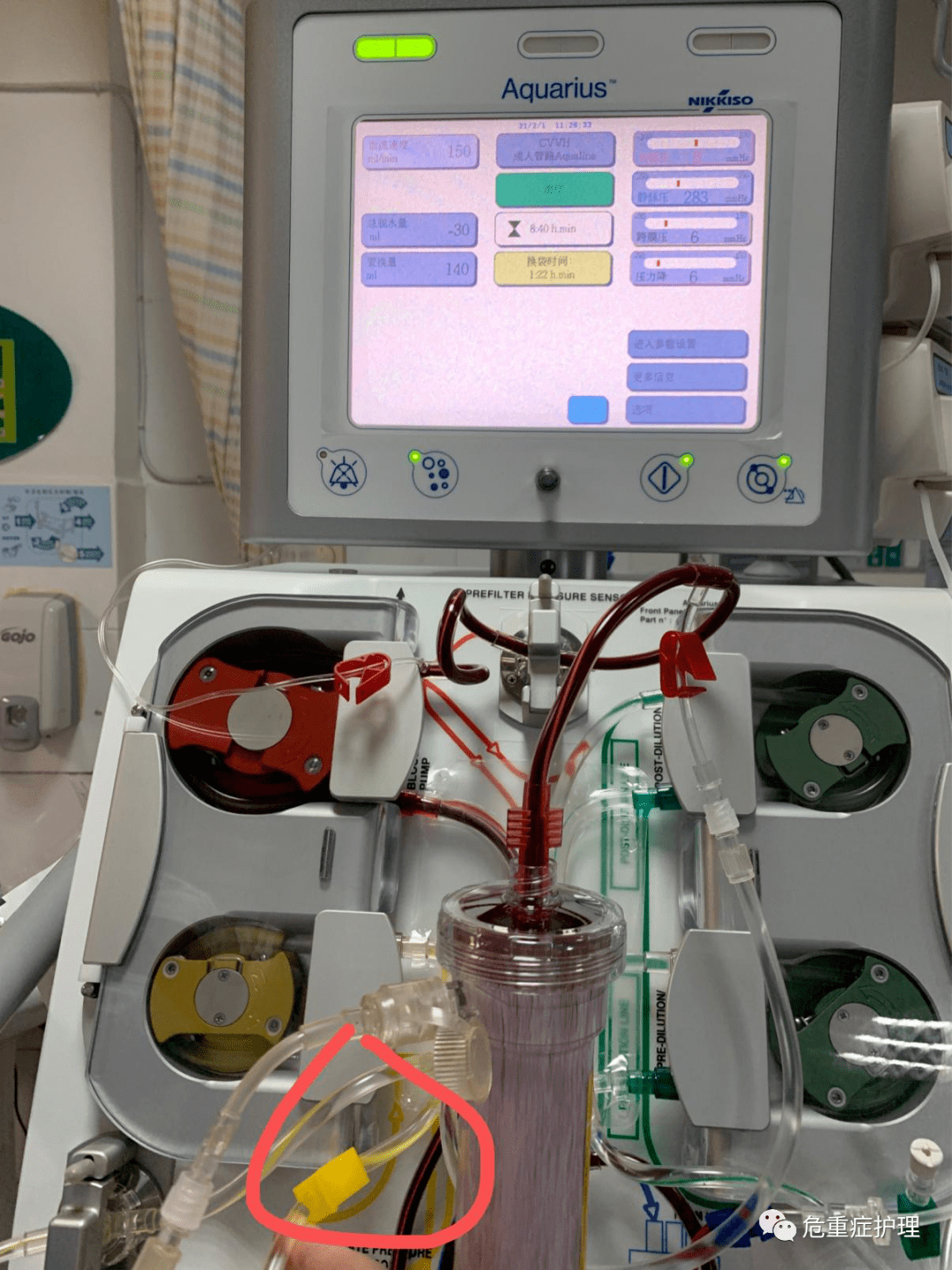 crrt总脱水量显示为负数你见过吗