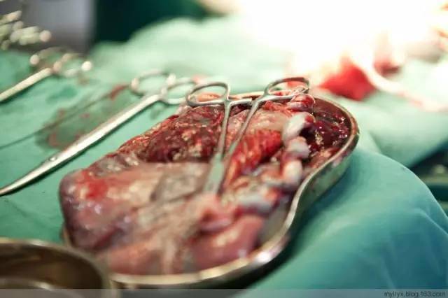 100张图片,揭秘剖腹产全过程!