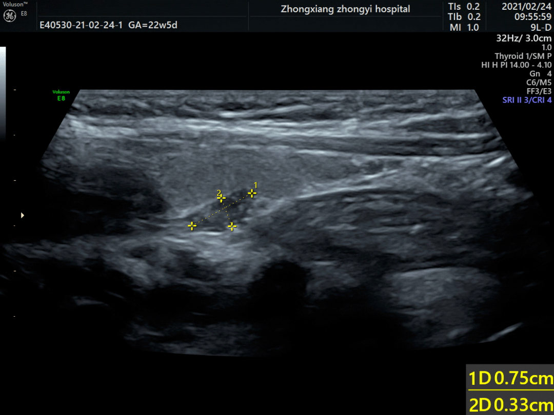 甲状腺左侧叶下方稍低回声结节,考虑异位胸腺.