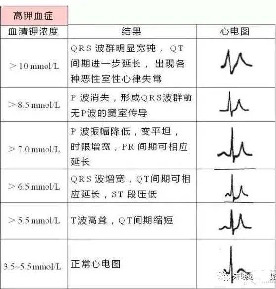 t波高尖心电图表现图片