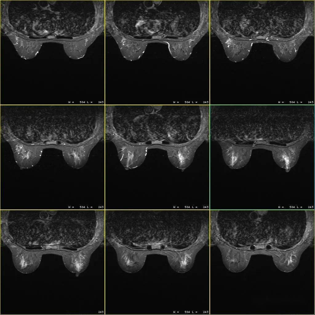 Aurora Dedicated Breast MRI Scanner - Model Information