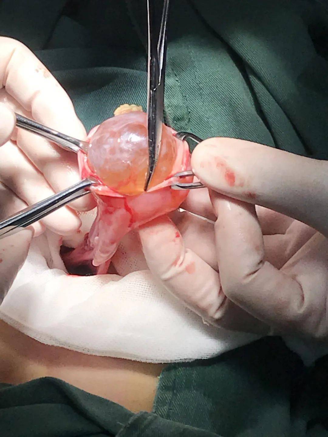 "既然不痛了,那我们就不要手术了吧,这个手术会不会切掉卵巢,对孩子的