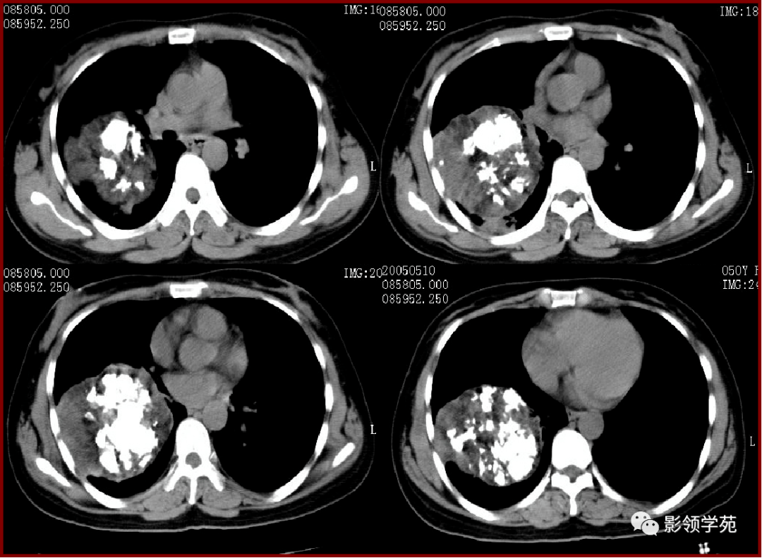 肺良性肿瘤影像表现