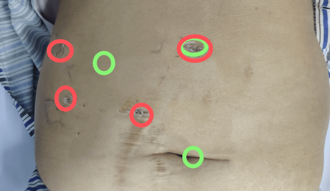 腾挪有术 腹腔严重粘连腹腔镜胆囊切除术 手术