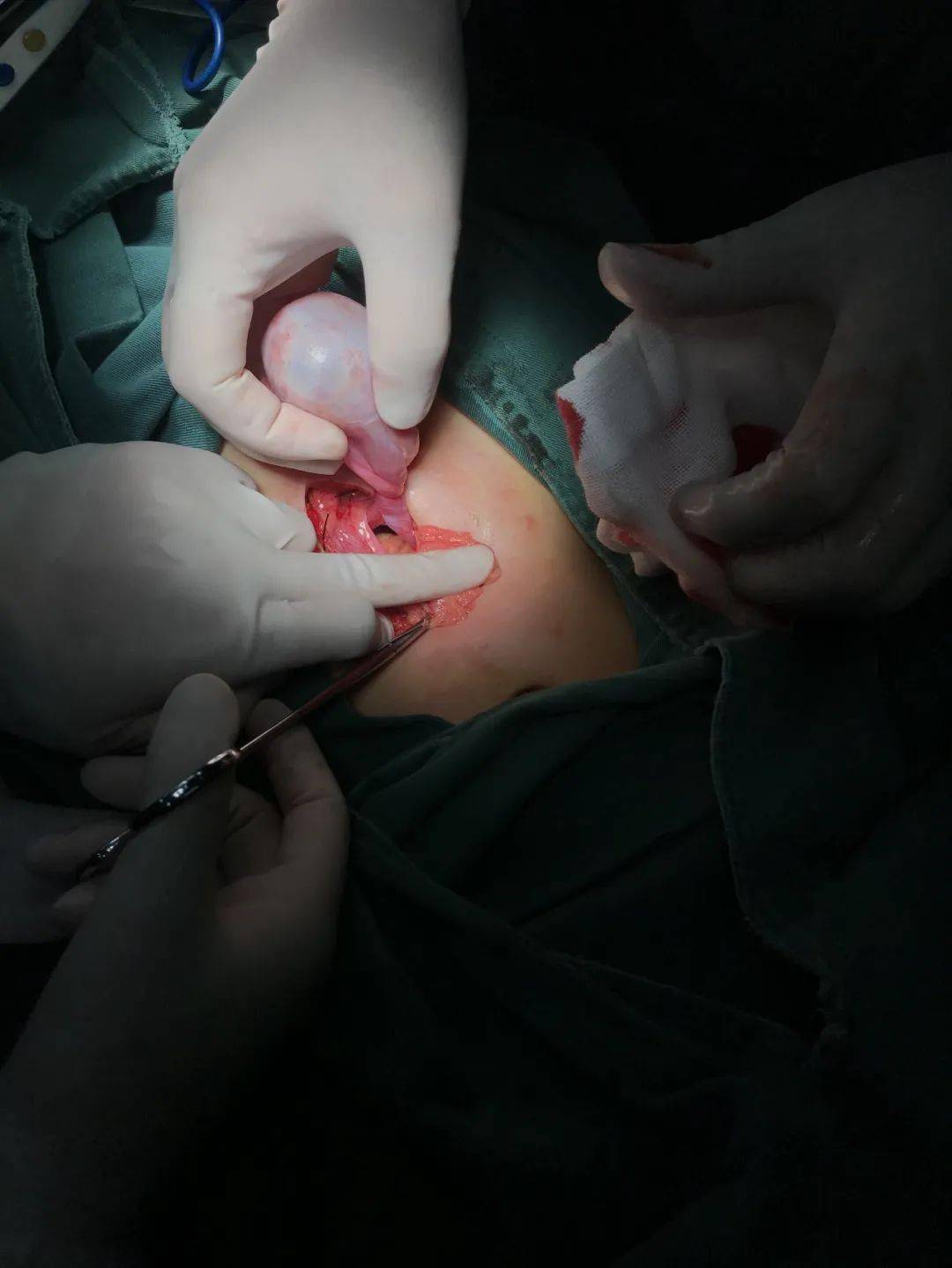 "既然不痛了,那我们就不要手术了吧,这个手术会不会切掉卵巢,对孩子的