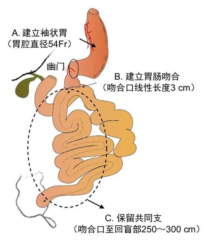 减肥手术切胃_手术减肥_减肥手术有什么危害