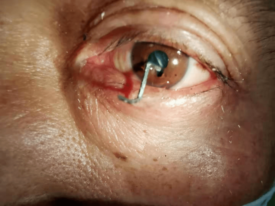 友谊技术拔除眼中钉