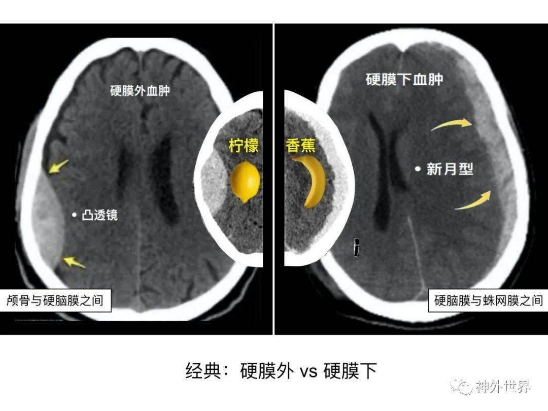 急诊头颅ct"3b"阅片法,这个阅片法值得推荐